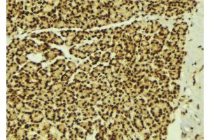 ABIN6269279 at 1/100 staining Human breast cancer tissue by IHC-P. (STAT5B 抗体  (C-Term))