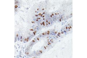 Immunohistochemistry of paraffin-embedded human colon carcinoma using RBPJK Rabbit mAb (ABIN1682563, ABIN3018511, ABIN3018512 and ABIN7101620) at dilution of 1:50 (40x lens). (RBPJ 抗体)