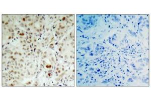 Immunohistochemical analysis of paraffin- embedded human breast carcinoma tissue using Rb (phospho-Ser807) antibody (E011131). (Retinoblastoma 1 抗体  (pSer807))