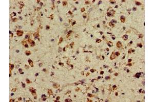 Immunohistochemistry of paraffin-embedded human glioma using ABIN7155470 at dilution of 1:100 (ASH1L 抗体  (AA 1906-2160))