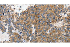 Immunohistochemistry of paraffin-embedded Human liver cancer tissue using GluR2 Polyclonal Antibody at dilution 1:70 (GRIA2 抗体)