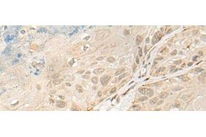 Immunohistochemistry of paraffin-embedded Human esophagus cancer tissue using OTX1 Polyclonal Antibody at dilution of 1:30(x200) (OTX1 抗体)