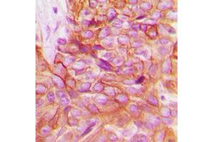 Immunohistochemical analysis of Alpha-adducin staining in human breast cancer formalin fixed paraffin embedded tissue section. (alpha Adducin 抗体  (C-Term))