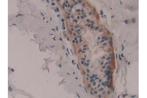 Detection of RPS6Ka1 in Human Breast cancer Tissue using Polyclonal Antibody to Ribosomal Protein S6 Kinase Alpha 1 (RPS6Ka1) (RPS6KA1 抗体  (AA 62-321))