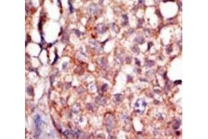 IHC analysis of FFPE human breast carcinoma tissue stained with the RIPK4 antibody (RIPK4 抗体  (AA 802-832))