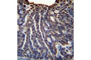 immunohistochemistry analysis in formalin fixed and paraffin embedded human ovarian carcinoma reacted with HOXB3 / HOX2G Antibody (Center) followed  which was peroxidase-conjugated to the secondary antibody, followed by DAB staining. (HOXB3 抗体  (Middle Region))
