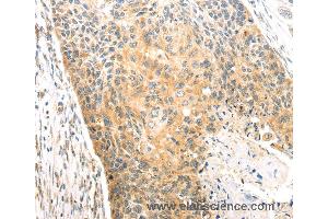 Immunohistochemistry of Human esophagus cancer using CAPN1 Polyclonal Antibody at dilution of 1:20 (CAPNL1 抗体)