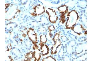 Formalin-fixed, paraffin-embedded human Renal Cell Carcinoma stained with Milk Fat Globule Monoclonal Antibody (EDM45) (MFGE8 抗体)