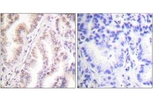 Immunohistochemistry analysis of paraffin-embedded human lung carcinoma tissue, using PIAS1 Antibody. (PIAS1 抗体  (AA 10-59))
