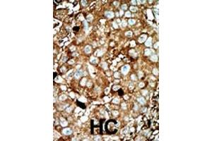 Formalin-fixed and paraffin-embedded human cancer tissue reacted with the primary antibody, which was peroxidase-conjugated to the secondary antibody, followed by AEC staining. (PFKFB3 抗体  (C-Term))