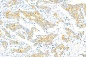 Immunohistochemistry of paraffin embedded human breast cancer using Epl4 (ABIN7073843) at dilution of 1:2000 (400x lens) (EFNA4 抗体)