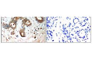 Immunohistochemical analysis of paraffin-embedded human breast carcinoma tissue, using 14-3-3 ζ (Phospho-Ser58) antibody (E011181). (14-3-3 zeta 抗体  (pSer58))