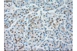 Immunohistochemical staining of paraffin-embedded Carcinoma of liver tissue using anti-SIGLEC9mouse monoclonal antibody. (SIGLEC9 抗体)