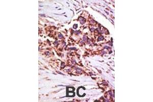 Formalin-fixed and paraffin-embedded human cancer tissue reacted with the primary antibody, which was peroxidase-conjugated to the secondary antibody, followed by DAB staining. (USP13 抗体  (AA 389-419))