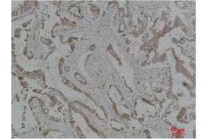 Immunohistochemistry (IHC) analysis of paraffin-embedded Human Breast Carcinoma using MEK-5 Polyclonal Antibody. (MAP2K5 抗体)