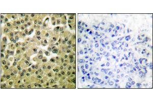 Immunohistochemical analysis of paraffin-embedded human breast carcinoma tissue using MCL1 antibody. (MCL-1 抗体)