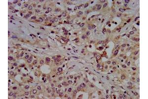 IHC image of ABIN7155172 diluted at 1:500 and staining in paraffin-embedded human liver cancer performed on a Leica BondTM system. (SLC7A1 抗体  (AA 430-492))