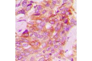 Immunohistochemical analysis of JAK1 staining in human breast cancer formalin fixed paraffin embedded tissue section. (JAK1 抗体  (C-Term))