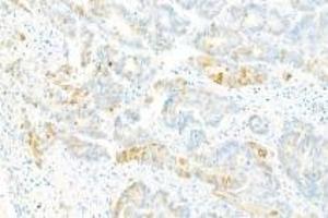 Immunohistochemistry analysis of paraffin-embedded Human ovarian cancer using Collagen X (ABIN7073549) at dilution of 1: 2000 (COL10 抗体)