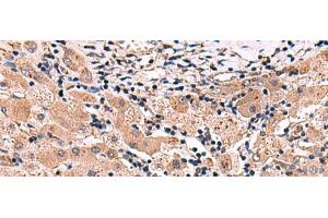 Immunohistochemistry of paraffin-embedded Human liver cancer tissue using INSC Polyclonal Antibody at dilution of 1:65(x200) (INSC 抗体)