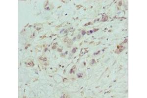 Immunohistochemistry of paraffin-embedded human pancreatic cancer using ABIN7148459 at dilution of 1:100 (COG5 抗体  (AA 1-260))