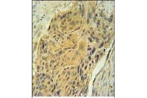 AVP Antibody (Center) (ABIN651748 and ABIN2840385) immunohistochemistry analysis in formalin fixed and paraffin embedded human lung carcinoma followed by peroxidase conjugation of the secondary antibody and DAB staining. (Vasopressin 抗体  (AA 102-129))