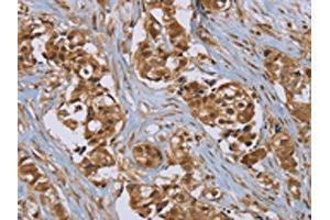The image on the left is immunohistochemistry of paraffin-embedded Human breast cancer tissue using ABIN7192079(PUS10 Antibody) at dilution 1/45, on the right is treated with synthetic peptide. (PUS1 抗体)