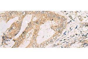Immunohistochemistry of paraffin-embedded Human cervical cancer tissue using SPACA1 Polyclonal Antibody at dilution of 1:50(x200) (SPACA1 抗体)