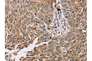 The image on the left is immunohistochemistry of paraffin-embedded Human lung cancer tissue using ABIN7130575(PDLIM7 Antibody) at dilution 1/35, on the right is treated with fusion protein. (PDLIM7 抗体)