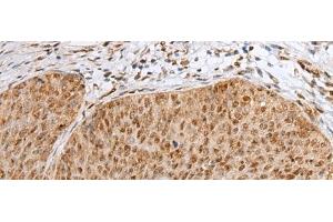 Immunohistochemistry of paraffin-embedded Human cervical cancer tissue using ZNF354A Polyclonal Antibody at dilution of 1:40(x200) (ZNF354A 抗体)