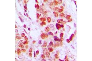 Immunohistochemical analysis of DDX52 staining in human breast cancer formalin fixed paraffin embedded tissue section. (DDX52 抗体  (C-Term))
