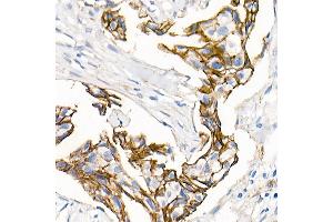 Immunohistochemistry of paraffin-embedded Human breast ductal carcinoma using δ-Catenin/p120 Catenin antibody (ABIN7266144) at dilution of 1:500 (40x lens). (CTNND1 抗体)