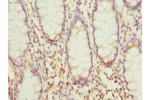 Immunohistochemistry of paraffin-embedded human colon cancer using ABIN7156012 at dilution of 1:100 (HSDL2 抗体  (AA 1-345))