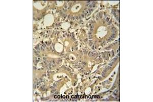 TPSD1 antibody (C-term) (ABIN654457 and ABIN2844191) immunohistochemistry analysis in formalin fixed and paraffin embedded human colon carcinoma followed by peroxidase conjugation of the secondary antibody and DAB staining. (TPSD1 抗体  (C-Term))