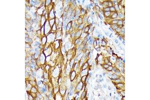 Immunohistochemistry of paraffin-embedded human esophageal cancer using Cytokeratin 6 (KRT6) (KRT6) Rabbit mAb (ABIN1680165, ABIN3019111, ABIN3019112 and ABIN7101717) at dilution of 1:100 (40x lens). (KRT6A 抗体)
