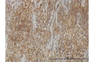Immunoperoxidase of monoclonal antibody to CAB39L on formalin-fixed paraffin-embedded human lymphoma tissue. (CAB39L 抗体  (AA 1-337))