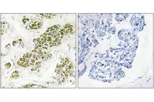 Immunohistochemistry analysis of paraffin-embedded human breast carcinoma tissue, using eIF2 alpha (Ab-51) Antibody. (EIF2A 抗体  (AA 21-70))