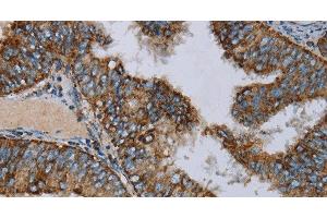 Immunohistochemistry of paraffin-embedded Human colon cancer using NDUFA9 Polyclonal Antibody at dilution of 1:30 (NDUFA9 抗体)