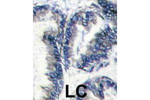 Formalin-fixed and paraffin-embedded human hepatocarcinomareacted with DCLK1 polyclonal antibody , which was peroxidase-conjugated to the secondary antibody, followed by AEC staining. (DCLK1 抗体  (AA 690-720))