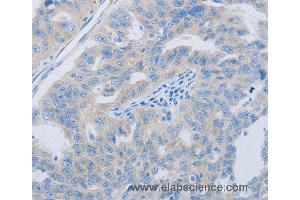 Immunohistochemistry of Human ovarian cancer using PAWR Polyclonal Antibody at dilution of 1:60 (PAWR 抗体)