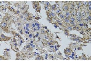 Immunohistochemistry of paraffin-embedded Human breast cancer using GNA15 Polyclonal Antibody at dilution of 1:100 (40x lens). (GNA15 抗体)