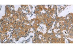 Immunohistochemistry of paraffin-embedded Human breast cancer using TNK2 Polyclonal Antibody at dilution of 1:70 (TNK2 抗体)