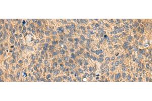 Immunohistochemistry of paraffin-embedded Human cervical cancer tissue using MIA Polyclonal Antibody at dilution of 1:100(x200) (MIA 抗体)