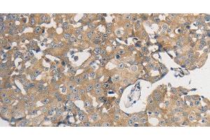Immunohistochemistry of paraffin-embedded Human breast cancer using PPP2CB Polyclonal Antibody at dilution of 1:50 (PPP2CB 抗体)