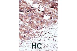 Formalin-fixed and paraffin-embedded human hepatocellular carcinoma tissue reacted with PHKG2 polyclonal antibody  , which was peroxidase-conjugated to the secondary antibody, followed by AEC staining. (PHKG2 抗体  (N-Term))