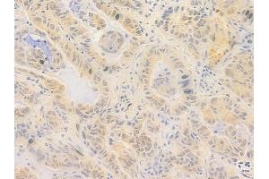 ABIN7096998 and ABIN7101065 at 1/100 staining human lung adenocarcinoma by IHC-P. (ZNF574 抗体)