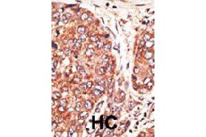 Formalin-fixed and paraffin-embedded human hepatocellular carcinoma tissue reacted with MAFK polyclonal antibody  , which was peroxidase-conjugated to the secondary antibody, followed by AEC staining. (Septin 9 抗体  (C-Term))