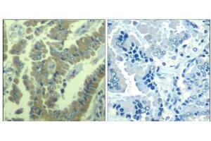 Immunohistochemical analysis of paraffin-embedded human lung carcinoma tissue using MARCKS(Phospho-Ser170) Antibody(left) or the same antibody preincubated with blocking peptide(right). (MARCKS 抗体  (pSer170))