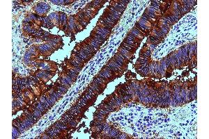 Immunohistochemistry staining of human colon adenocarcinoma (paraffin sections) using anti-blood group Lewis b (clone 2-25LE). (Blood Group Lewis B 抗体)