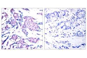 Immunohistochemical analysis of paraffin-embedded human breast carcinoma tissue using c-Jun (phospho-Thr93) antibody (E011022). (C-JUN 抗体  (pThr93))